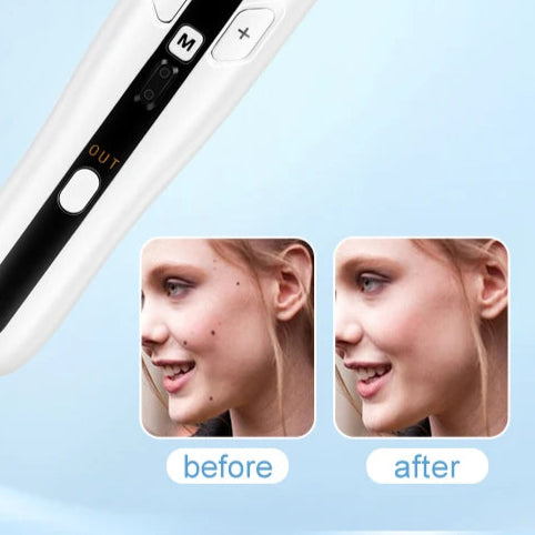 Precision Meets Renewal – 2-in-1 Ozone Plasma Pen for Skin Lifting, Spot Removal & Gentle Confidence